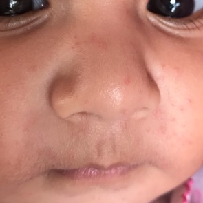 My Daughter Is 5 Mnth Old I Recognize Small Red Dots On Her Face Their Is No Pain N Irritation But Cant Able To Understand What Is It And Why They R On My