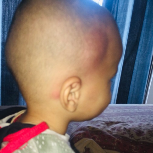 Why Does My Baby Have A Lump On His Head - Infoupdate.org